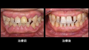 中程度 重度歯周病に対して歯周治療を行った症例 広島市中区の歯医者 審美歯科 ごこちデンタルクリニック 中程度 重度歯周病に対して歯周治療を行った症例 広島市中区の歯医者 審美歯科 ごこちデンタルクリニック